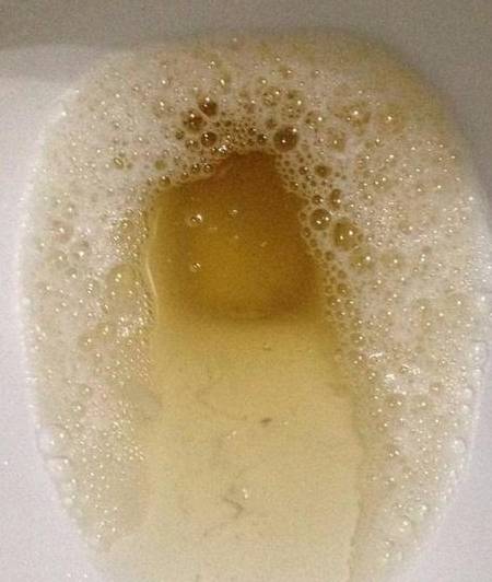 疾病_蛋白尿_相关