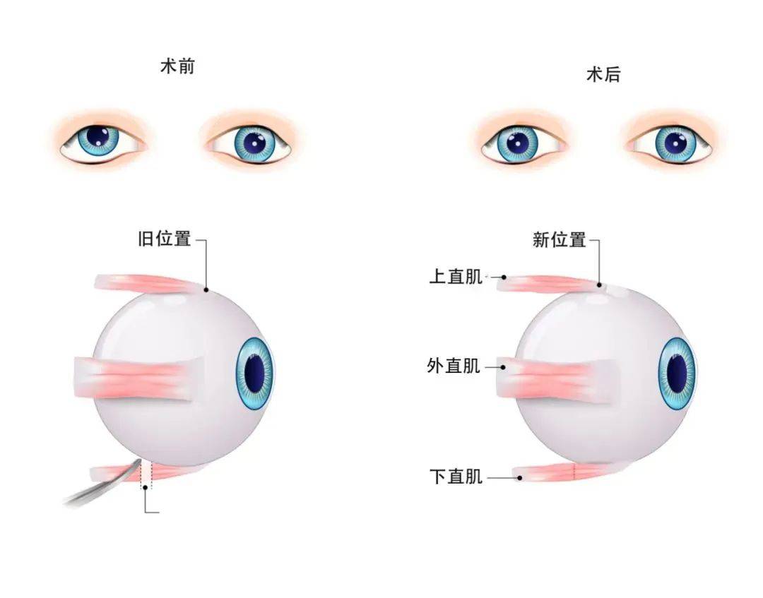 关于儿童斜视,你知道上海斜视手术大概多少钱?_孩子_双眼_功能