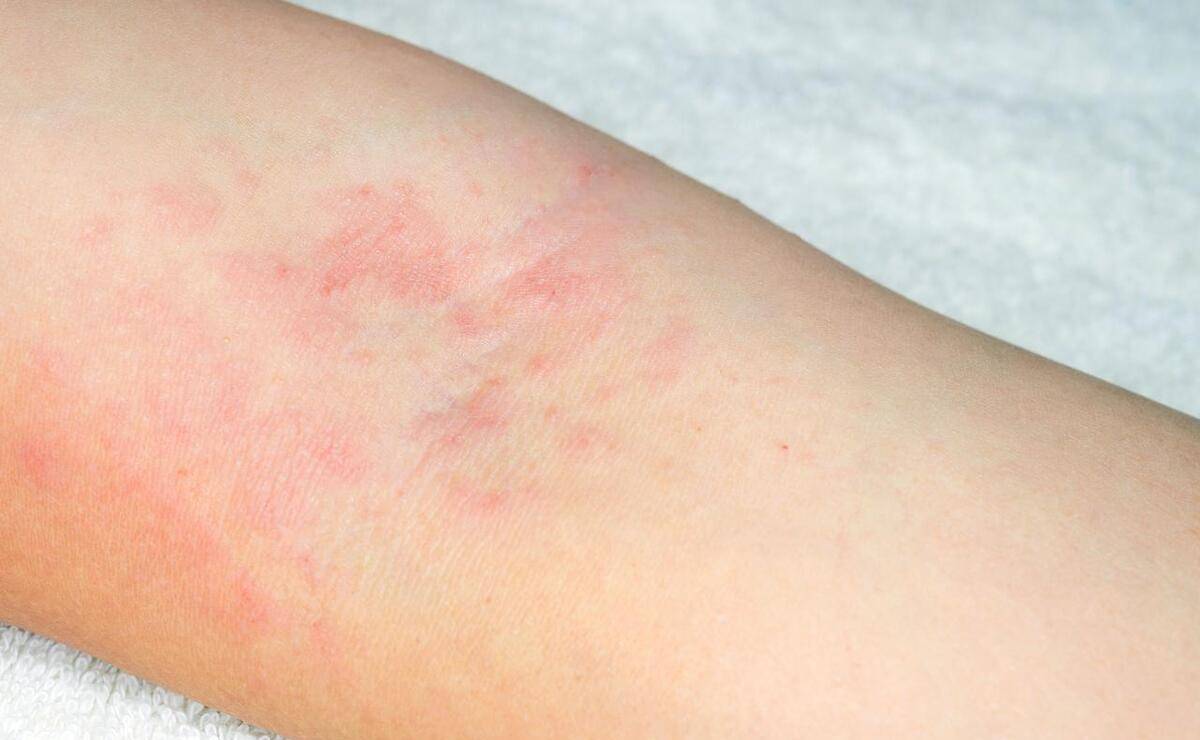 过敏的症状:布洛芬可引起过敏的症状,包含小红点,呼吸不畅,喉咙水肿