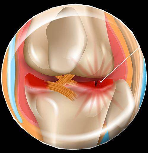 外侧半月板撕裂图片