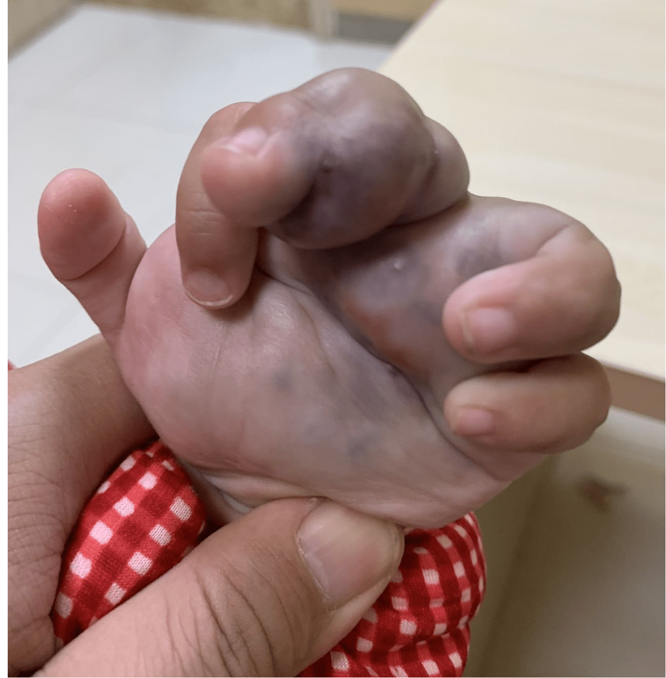 徐州市儿童医院科普:儿童巨大静脉畸形介入硬化治疗经验分享