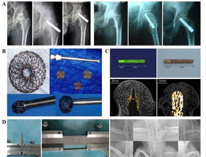 生物材料在早期股骨头新伤诊治中的应用_治疗_聚合物_血管