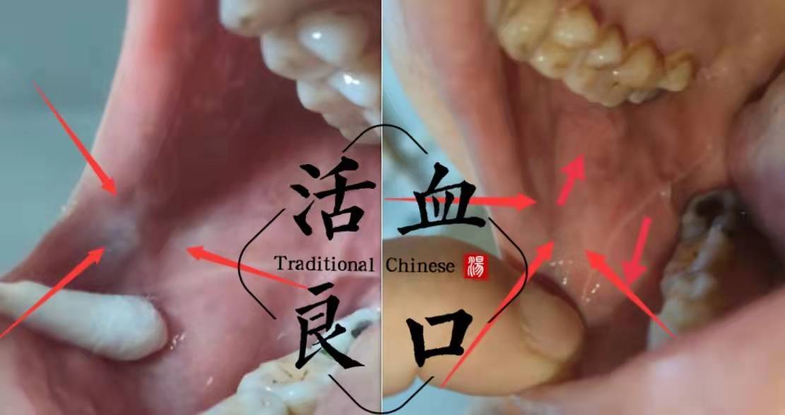 口腔扁平苔蘚白斑白紋沒有了太開心了_黏膜_疾病_調節