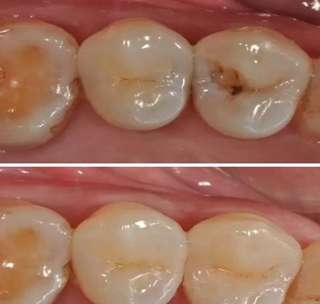 患上蛀牙后牙痛难忍,牙齿坏了一半,医生为什么不让我补牙?