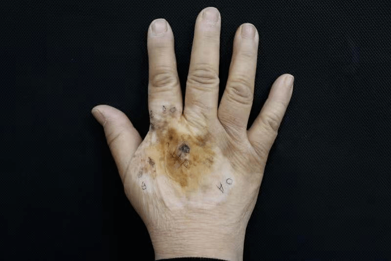 盘点那些罕见皮肤病|黑色素瘤变白色,岂能颜色辨良恶?_白斑_肿瘤_患者