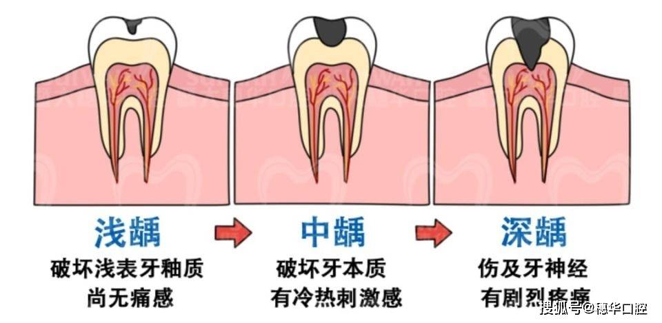 中 齲隨著淺齲進一步發展,齲洞已經突破牙釉質層,進入牙本質層,但是還