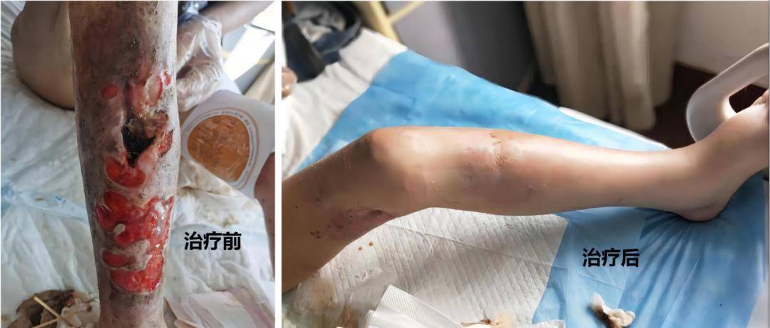 骨结核和骨髓炎哪个更严重?_治疗_消息_疾病