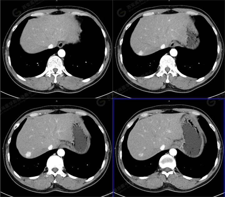 肝右后叶ct图片