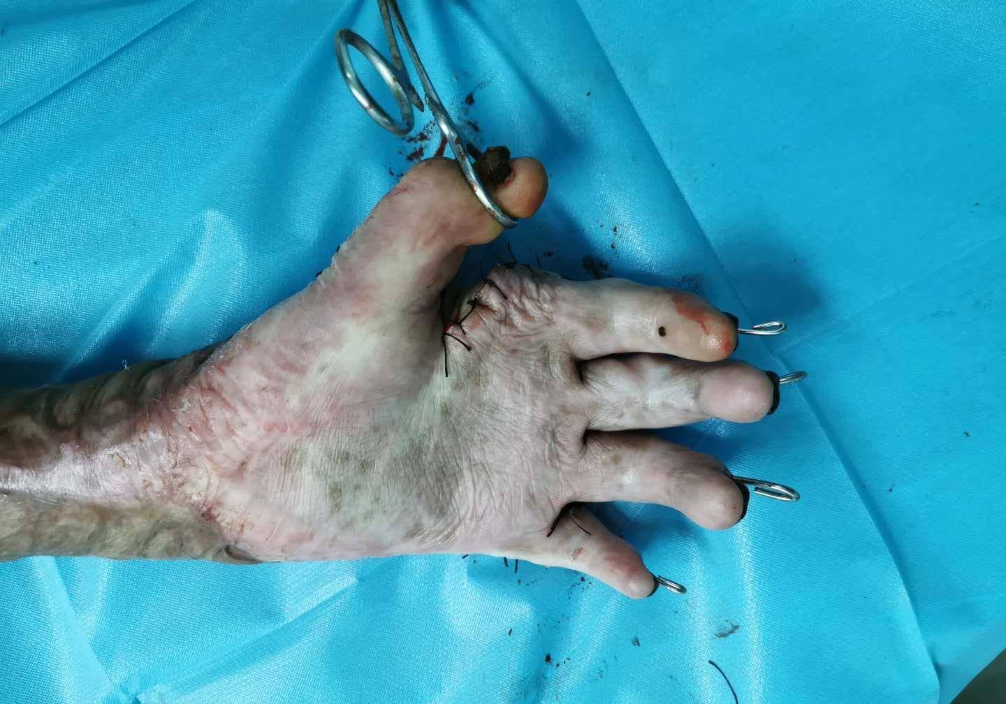 烧伤后关节瘢痕挛缩怎么办?外科医生有什么治疗建议?_患者_手术_移植