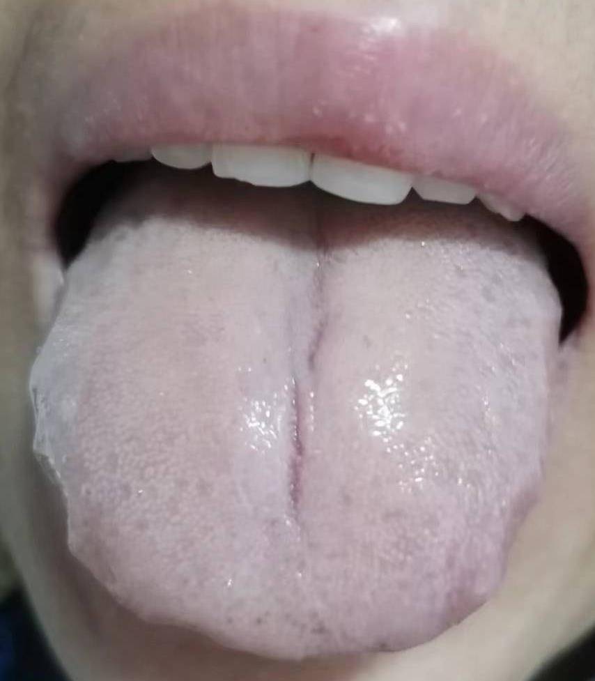 胆结石的舌象图片图片