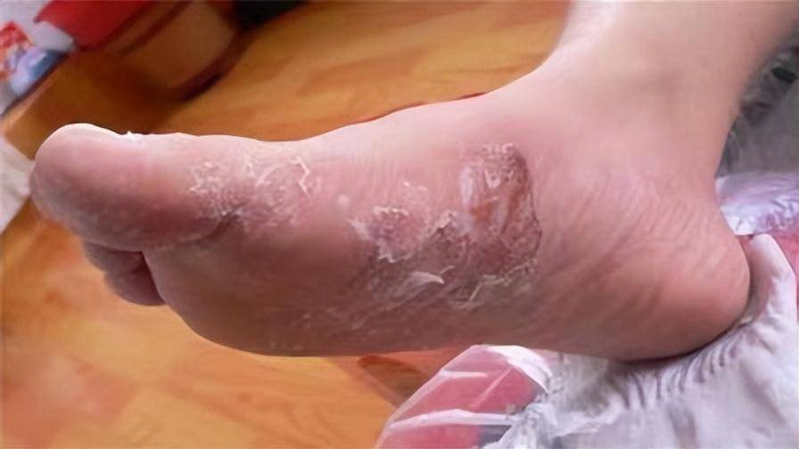 8年脚气30天断根!自用方法免费分享!_效果_时候_皮肤