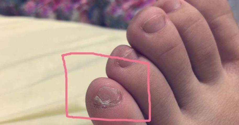 小脚趾甲两瓣 来自搜狐网