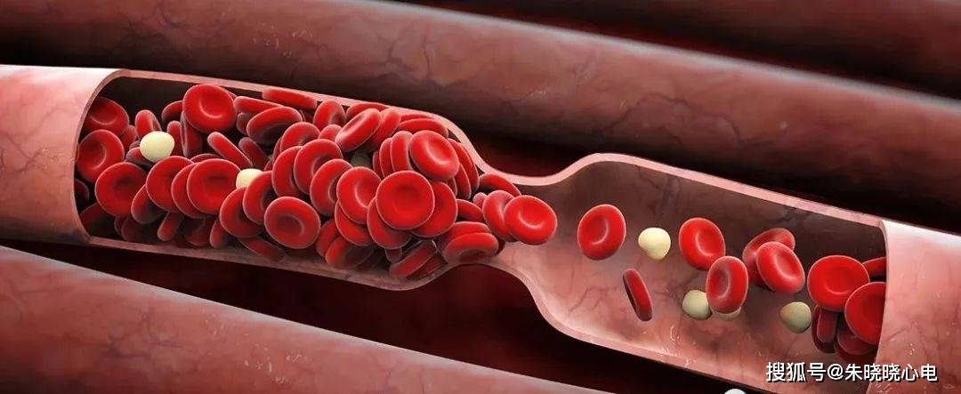 st段抬高与非st段抬高心梗的这些区别_病变_血栓_循环