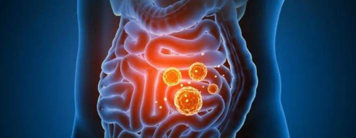 直肠癌多半是"拖"出来的?