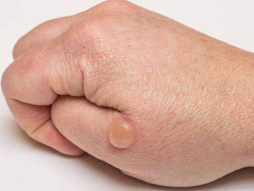 为什么脚上会长水泡?解决方法在这里!_皮肤_摩擦_处理