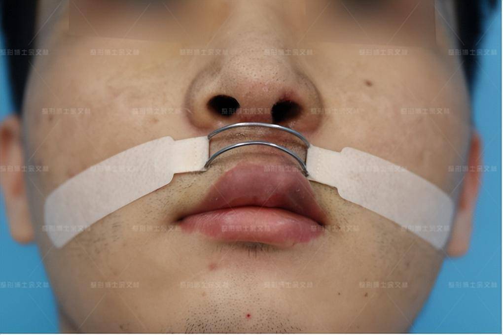 唇裂专家余文林:唇裂修复后贴的唇弓是什么?_护理_患者_效果