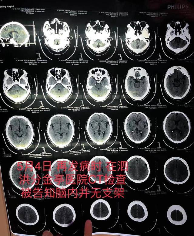 老人脑梗去世 医生隐瞒未植入支架