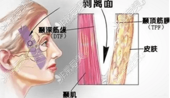 调研：筋膜悬吊面部提升术多少钱？筋膜悬吊面部提升术价格难以统一？-筋膜悬吊效果消失了会不会更丑