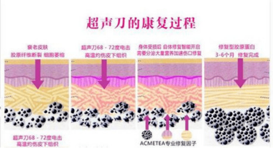 超声炮的危害和副作用、反容貌焦虑图鉴-超声炮的功效