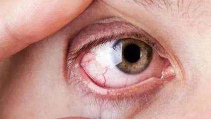眼睛这症状可能是癌图片