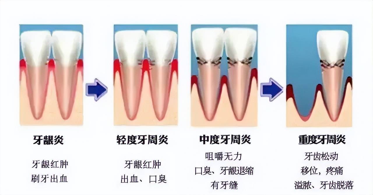 牙龈萎缩怎么防治?_牙齿_口腔_牙根