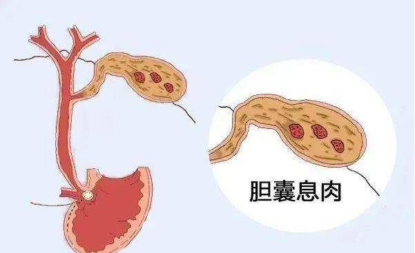 医生:警惕沉默的杀手-胆囊结石_症状_治疗_大部分