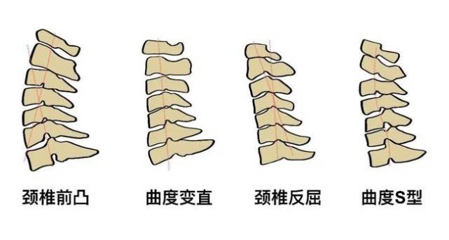 人体颈椎曲度