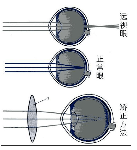 眼视光基础part 4---屈光不正