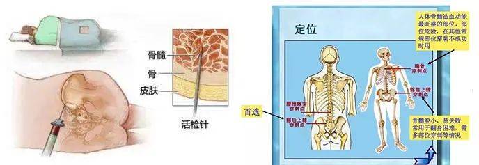 mpn家园携手血液专家一起为您揭开有关骨髓穿刺的秘密