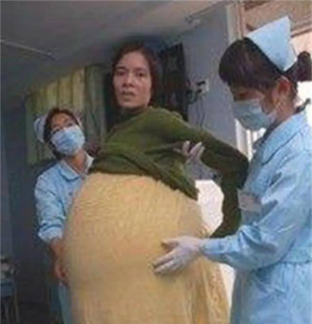 09年广东"巨腹"女人患癌被丈夫抛弃,今已康复,成3个孩子的妈_细妹