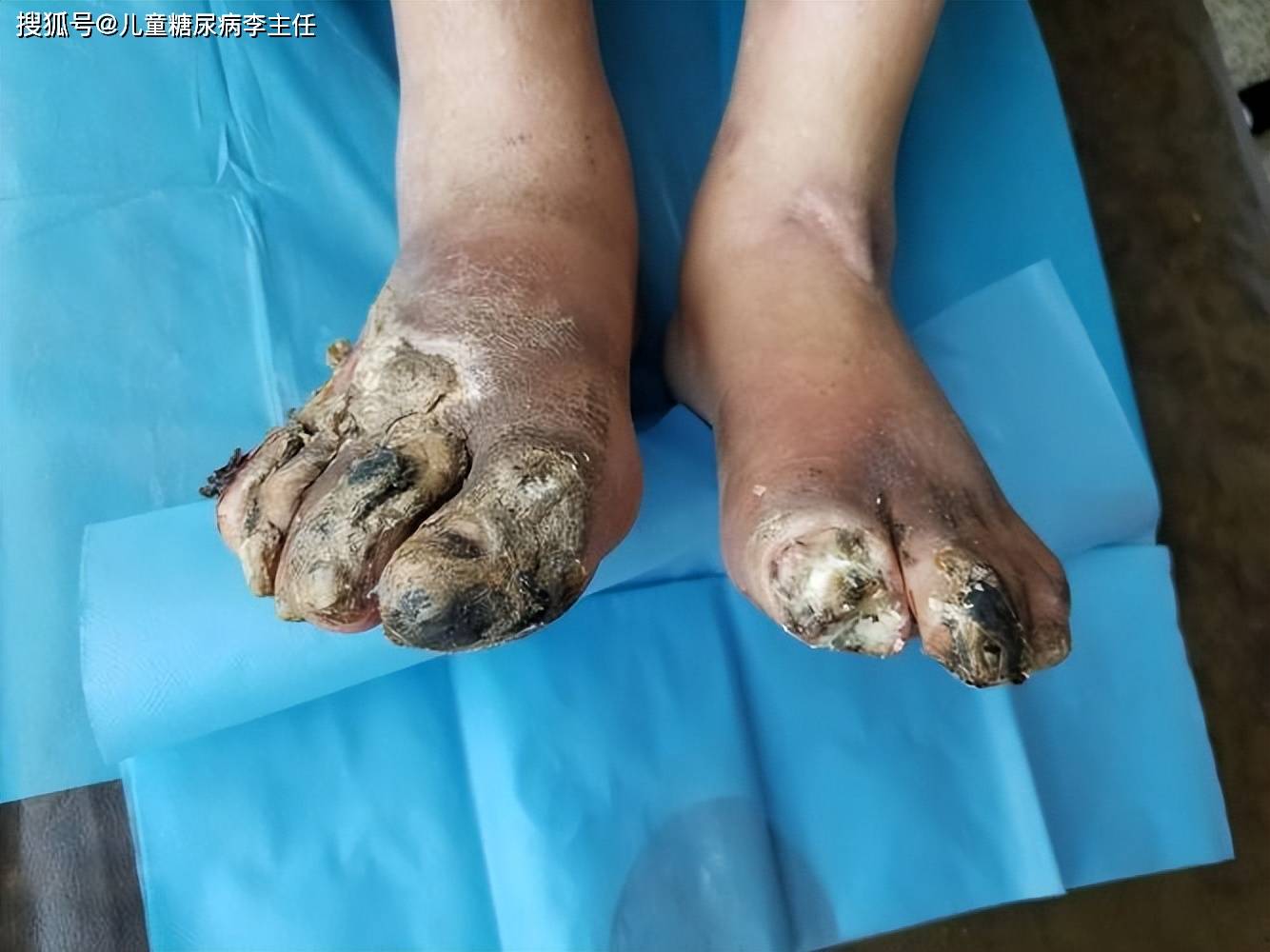 糖尿病足!_孩子_坏疽_肌肤