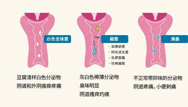 女性外阴炎症状图图片