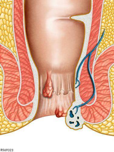 肛门癌真实图片图片