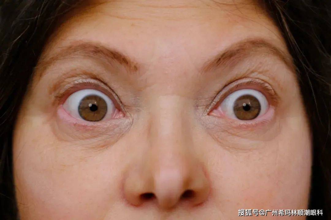 变大,变突?这种眼病女性高发,千万注意_甲状腺_眼球_相关性