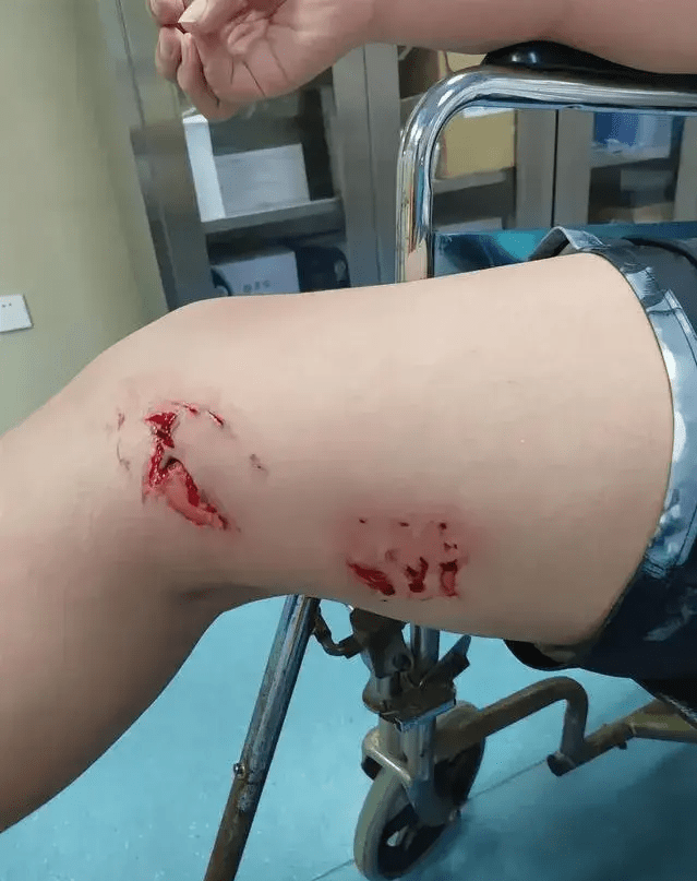 被鲨鱼咬伤的伤口图片图片