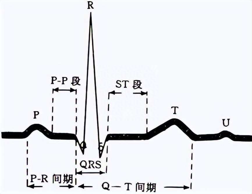 st-t改变心电图图片