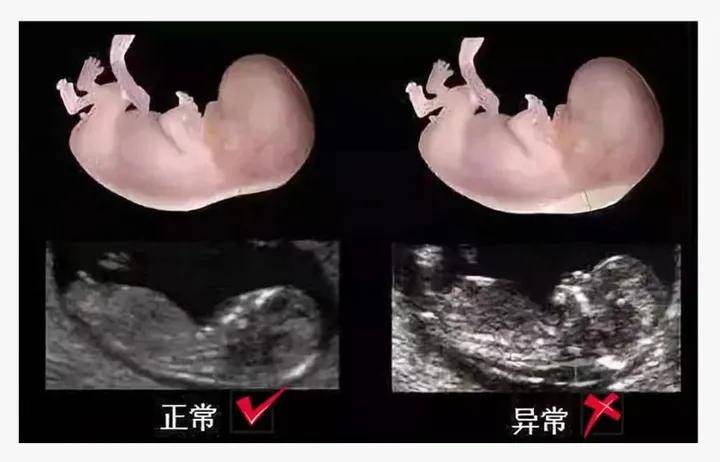 nt检查什么内容?需要空腹憋尿吗?和普通b超有什么关系?