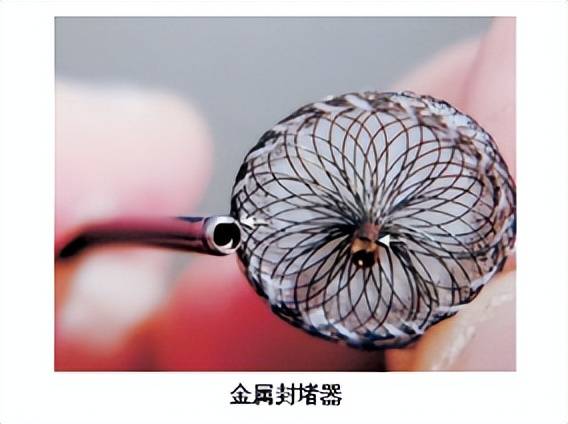 的陶瓷膜封堵器,还有通过升级表面处理工艺,在镍钛合金丝表面形成均匀