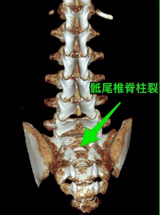 7岁还漏尿 查出隐性脊髓栓系综合征