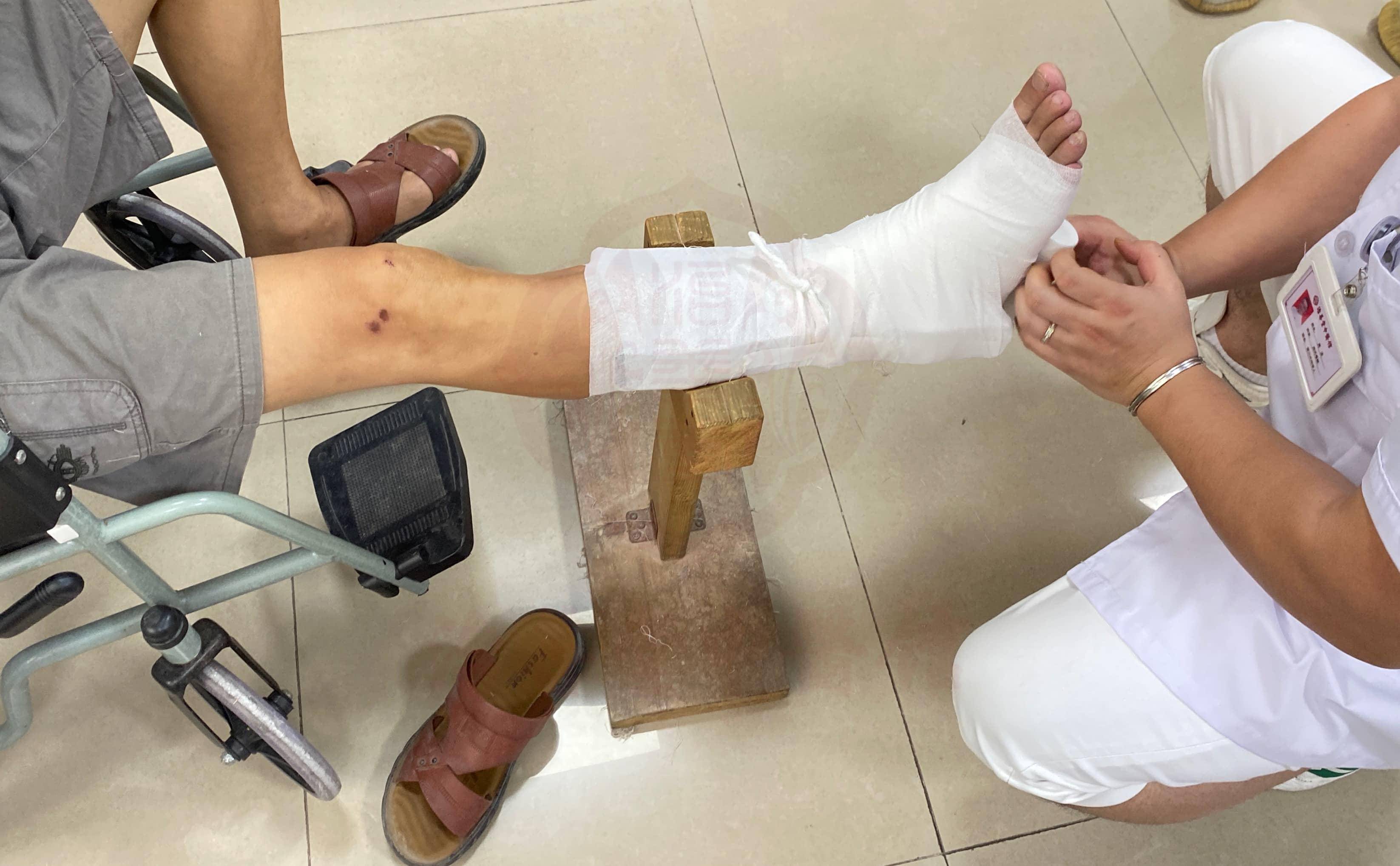 怎样才算接骨成功?关注愈合,功能恢复和外形正常