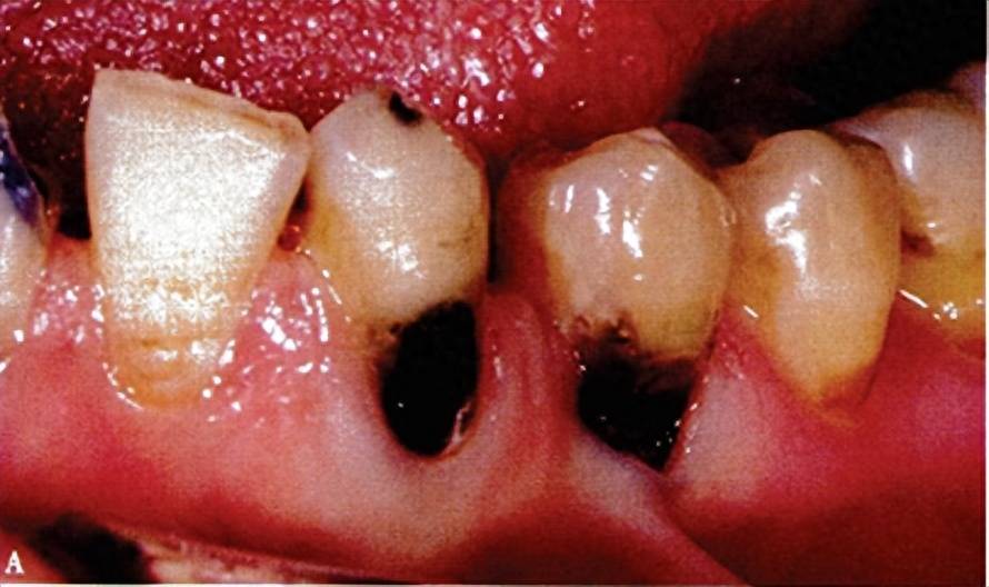 图注:根面龋 图片源自人民卫生出版社第五版《牙体牙髓病学》或产生根