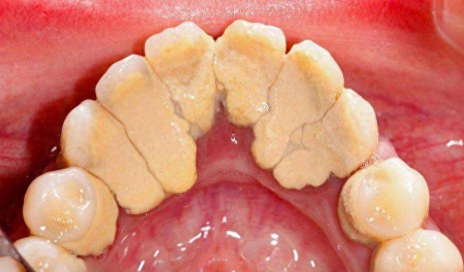 掌握这几招,牙垢牙石自动脱落!_牙粉_牙齿_口腔