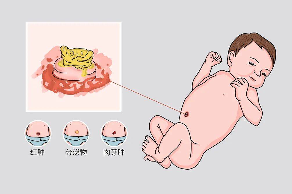 婴儿脐疝处理图片