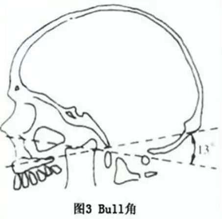 此外还有bull角:为硬腭平面与寰椎平面的角度正常小于 13°,大于 13