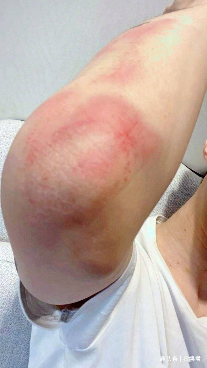 林家栋受伤额头缝10针无人问,范丞丞摔倒胳膊红肿有人疼,为什么_因为