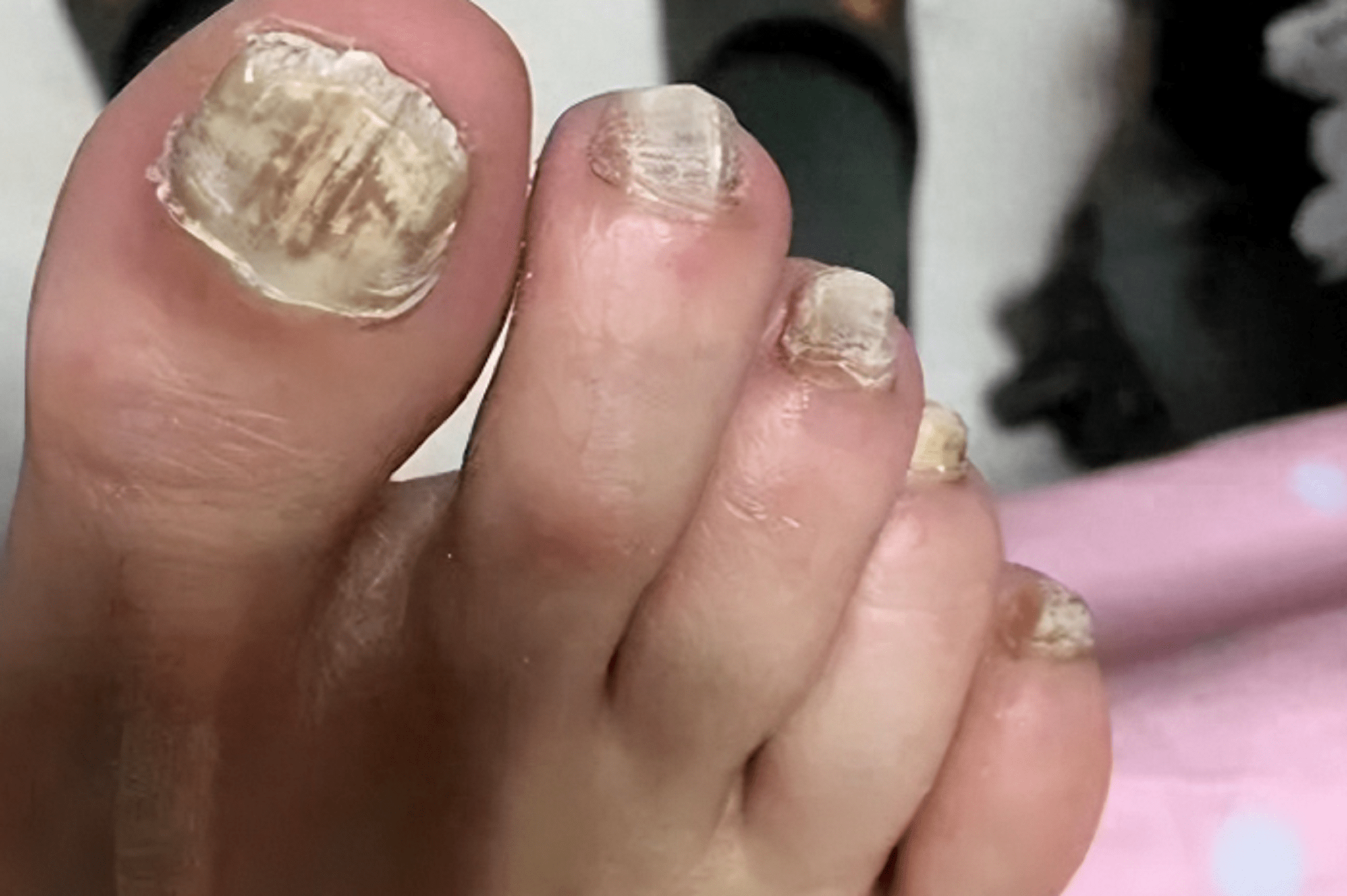 灰指甲根治不反灰!原来关键是这2点,学到受益终身!