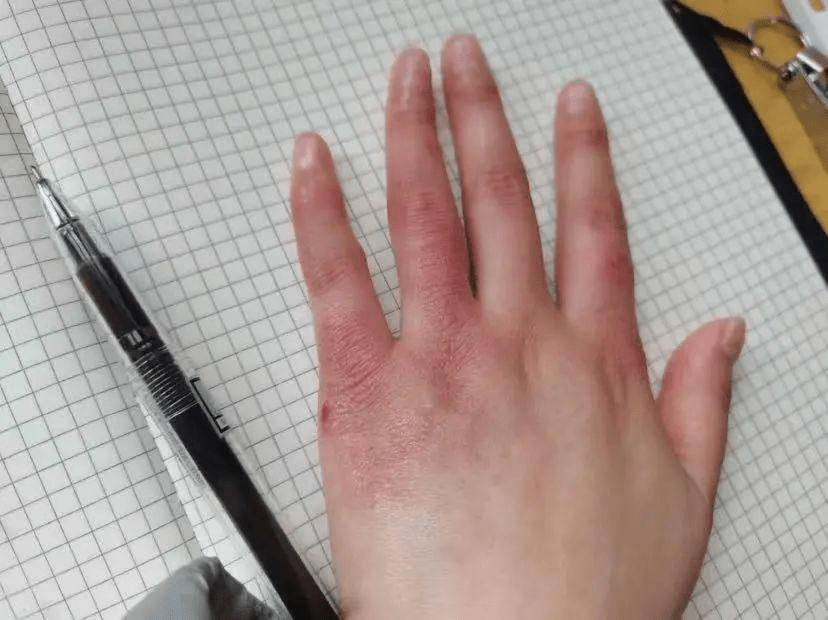 效果_防治_手指