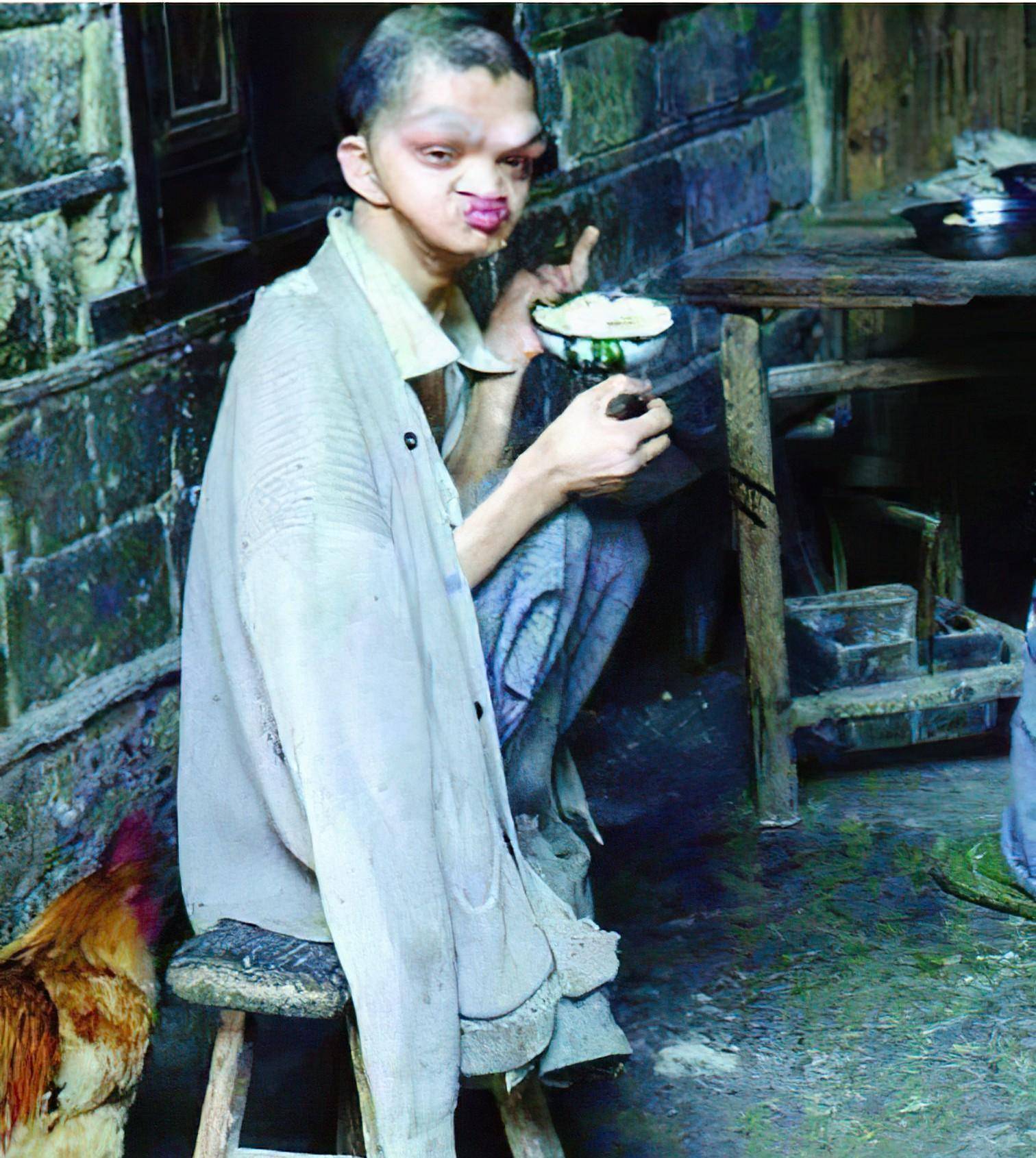 2007年,湖南小伙长相怪异如"猴人",爬行树林间智力仅2岁