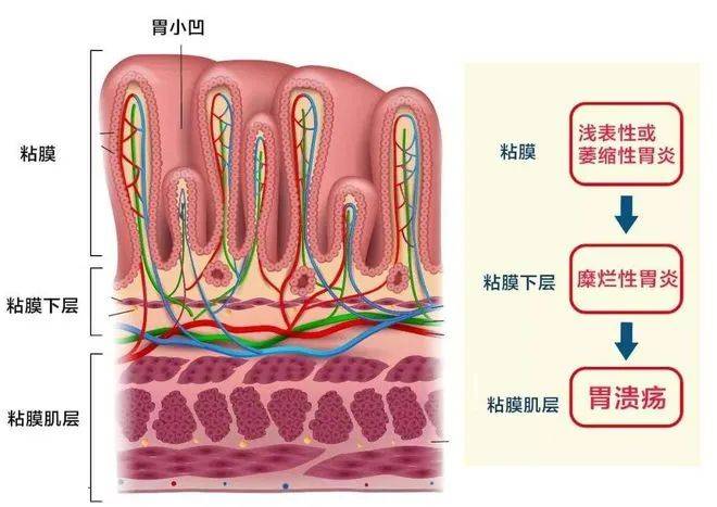 胃溃疡底部四层结构图图片