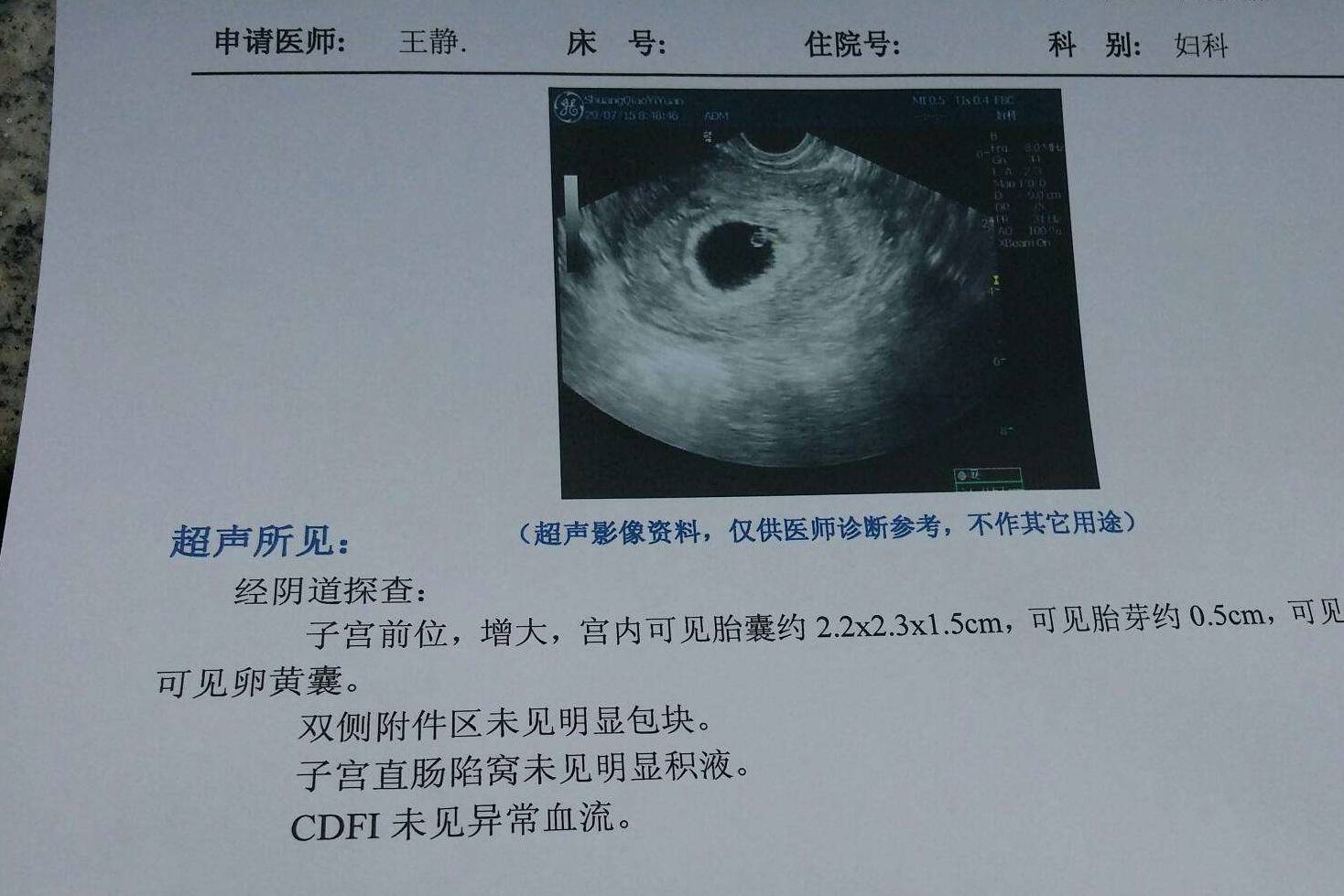 怀双胎的检查b超图片图片